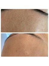 エステティック トリートメント クオリティ(Esthetic Treatments Quality)/毛穴ごっそりリバウンドゼロ！