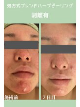 ハーシークレット(Her secret)/ブレンドハーブピーリング７日目