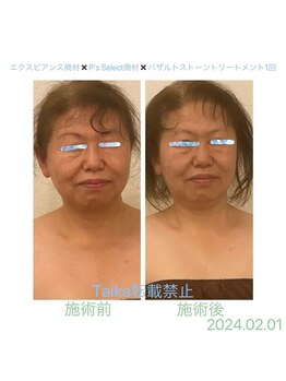 タイカ(Taika)/小顔/ほうれい線◎