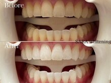 最新技術【超音波×LEDホワイトニング】1回でのビフォーアフター