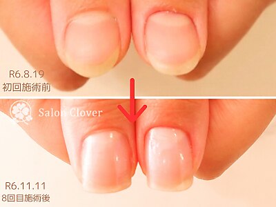 【爪の形にお悩みの方】自爪を縦長へ導く美爪育成ネイルケア/体験\6600