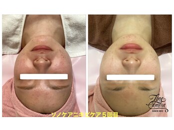 ロゼブランシュ(Rose Blanche)/毛穴、ニキビケアフェイシャル☆