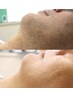 MENSヒゲ脱毛特許取得のハイレベル脱毛！ヒゲ全体1回¥13,200