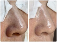 ロイジエ(Loyijie.w)/毛穴も綺麗、透明感アップ