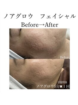 スターティス(STATICE)/ノアグロウ フェイシャル