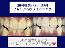 ホワイトニングカフェ 豊中店(WhiteningCafe)/◎ホワイトニングカフェ