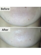 美鼻ラボ 押上 曳舟/顎もザラつきないですか！？