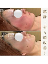 ビューティ ワンド ユズ(Beauty Wand YUZZ)/アンストレス　２回