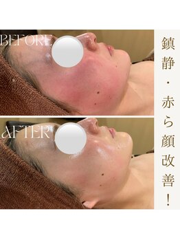 ビューティ ワンド ユズ(Beauty Wand YUZZ)/アンストレス 2回