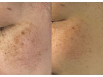 モガナ(mogana)/50代・お肌に優しいシミケア