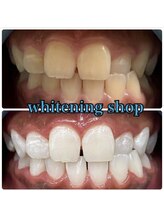 ホワイトニングショップ 池田店/【BEFORE/AFTER】