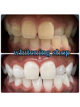 ホワイトニングショップ 池田店/【BEFORE/AFTER】