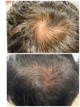 メディカルサンテロッソ 福岡店(MEDICAL SANTEROSSO)/エクソソームで育毛を促進