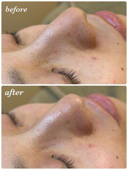 エムベル 越谷レイクタウン店(M belle)/エクストラクションbefore/after