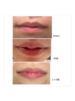 リリーガーデン 手稲店(Lily Garden)/before after【ローマピンク】