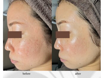 アン ビューティー(ann beauty)/施術2回【症例写真】30代