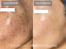 リアン/エステだから優しいシミケア