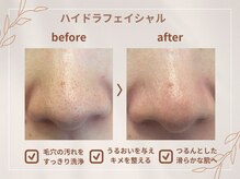 シロ(CHILO)/ハイドラbefore・after