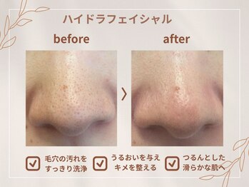 シロ(CHILO)/ハイドラbefore・after
