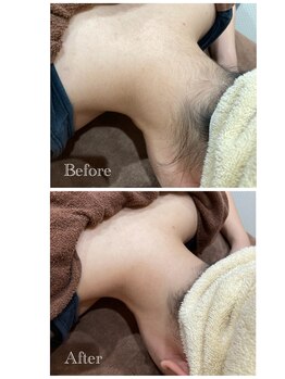 ヘアーメイク デビュー(Hair Make Debut)/首後ろ(えりあし)脱毛