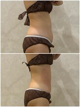 OBS新潟整骨院/脂肪冷却でぽっこりお腹解消中♪