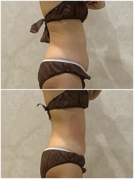 OBS新潟整骨院/脂肪冷却でぽっこりお腹解消中♪