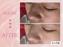 クリアラボ 上野(Clear Lab)/韓国肌管理&毛穴洗浄専門店