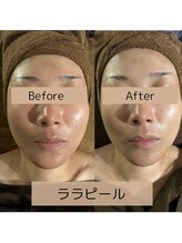 カヨン 新所沢店(KAYON)/敏感肌のお客様　1年間ご継続