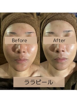 カヨン 新所沢店(KAYON)/敏感肌のお客様　1年間ご継続