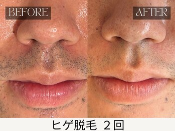 スキンジム(SKIN GYM)/しぶとい鼻下も2回でまずは減毛