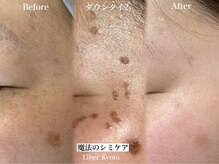 リベルキョウト 京都駅前店(Liber Kyoto)/魔法のシミケア