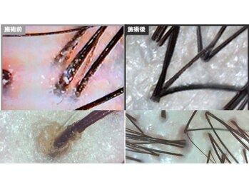 ワヤンプリ 横浜店/頭皮スコープ診断