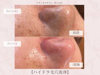 ビベル 八木店(Bebelle)/40代の気になる毛穴にアプローチ