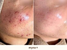 マイナプラ 表参道(myna+)/CHRISTINA/ハーブピーリング