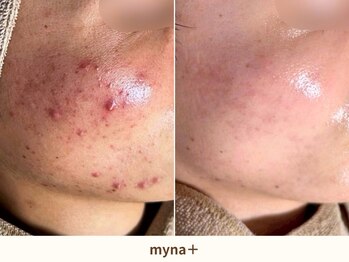 マイナプラ 表参道(myna+)/CHRISTINA/ハーブピーリング