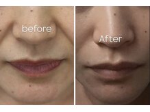 ハイム(HAYIM)/透明感/ほうれい線ケア