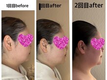 ブルーム(bloom)の雰囲気（韓国発！脂肪撃退！パンパンむくみ顔からスッキリ小顔に！）