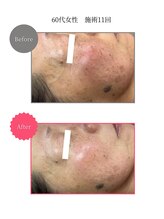 ボータン 恵(Beau Temps)/ウルトラ光トーニング/シミ改善