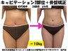 【40.50代の方へ！】徹底引き締め☆脂肪燃焼キャビテーション3部位×骨盤矯正