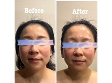 エヌプラスビューティー(N+beauty)/モヤモヤフェイスラインにも！