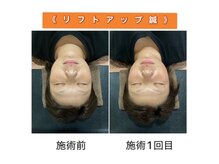 ワンドア(ONEDOOR)の雰囲気（道内希少★立体造顔美容鍼上級技術認定院◎リフトアップ美容鍼♪）