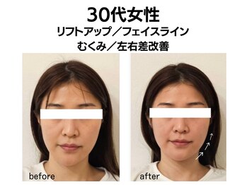 シン(SHINE)/美容鍼灸