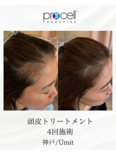 ユミト(Umit)/プロセルスカルプ