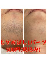 リアンジュ/髭脱毛の経過