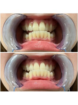 ワイズサロン(Y's salon)/ホワイトニング1回の症例です!