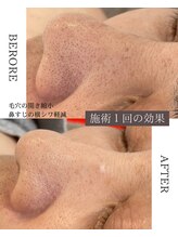 ルシェビューテイー(Luche Beauty)/WiQo水光ピーリングの一回の効果