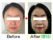 小顔矯正エステ プリュムレーヴ/ 40代｜むくみたるみ改善