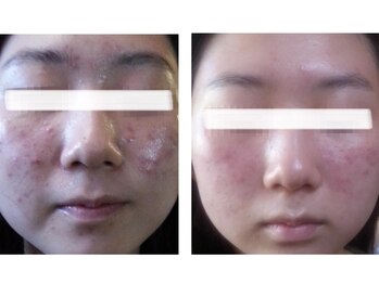 リリー(Lily.)/ニキビ肌の改善