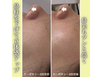 ハニエル(Haniel)/カーボキシー症例