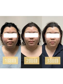 ベルフィーヌ 恵比寿店(BELFINE)/左右の整った美しい小顔に★